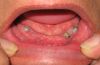 Zahnimplantate und Einheilkappen