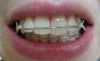 Crozat fÃ¼r Zahnregulierung und Bisskorrektur