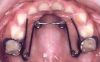 Feste Spange (Quadhelix) an erst 3-jähriger Patientin