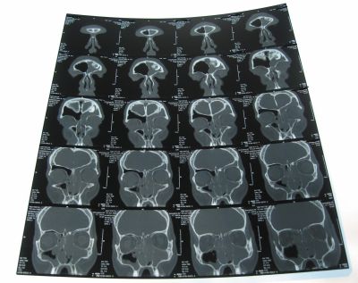 Computertomografie CT