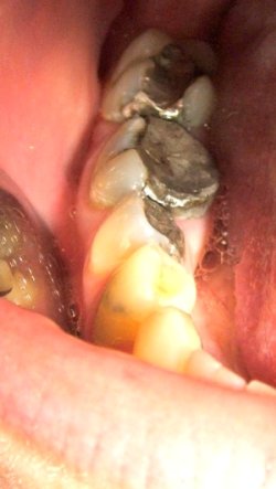 Amalgamfüllung Amalgam