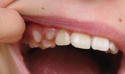 Dentition Dentition