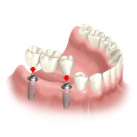 Zahnimplantat Beispiel