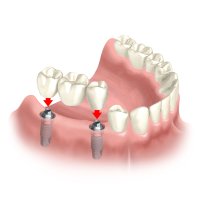 Beispiel Implantat