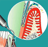 Parodonstoseinstrument 2