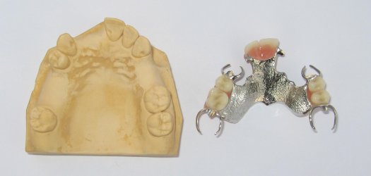 Schaltprothese Bild