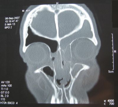 Computertomographie_Sinusitis Sinusitis